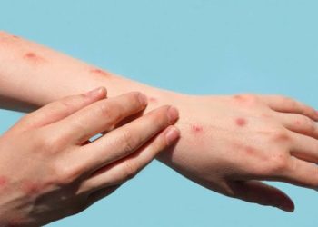 WHO Tetapkan MPOX Tidak Lagi Darurat Kesehatan Masyarakat